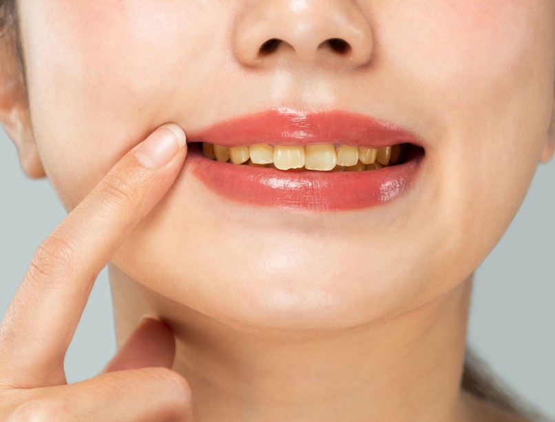 fogelszíneződés étel ital fog sárga