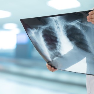 Tüdőgyulladás - még ma is igen veszélyes az influenza gyakori szövődménye című cikk nyitóképe