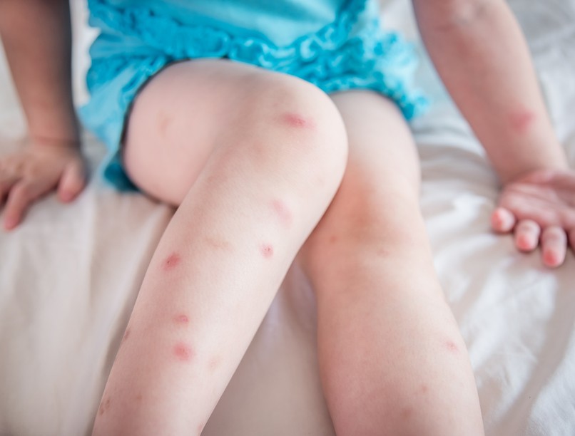 ágyi poloska, csípés, tábor, gyerek