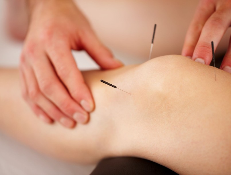 akupunktúra fájdalomcsillapítás migrén ízületi gyulladás