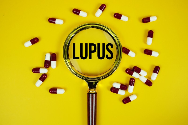 Lupusz – tünetek, diagnózis, kezelés: amit minden érintettnek tudnia kell