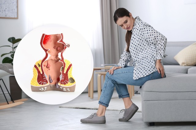 Lüktető fájdalom és makacs váladékozás a végbélből: felejtse el a házi kenegetést! Ez az egyetlen valódi megoldás a sipoly ellen