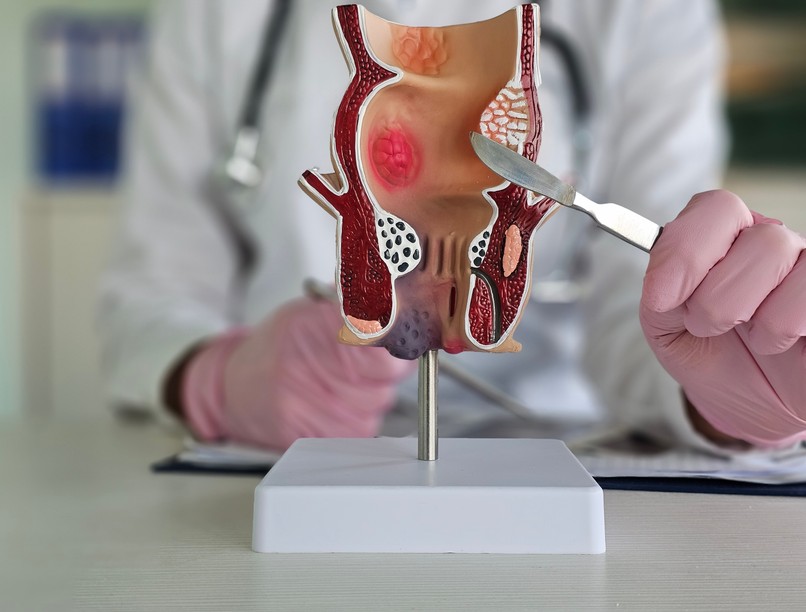 Divertikulum béltágulat