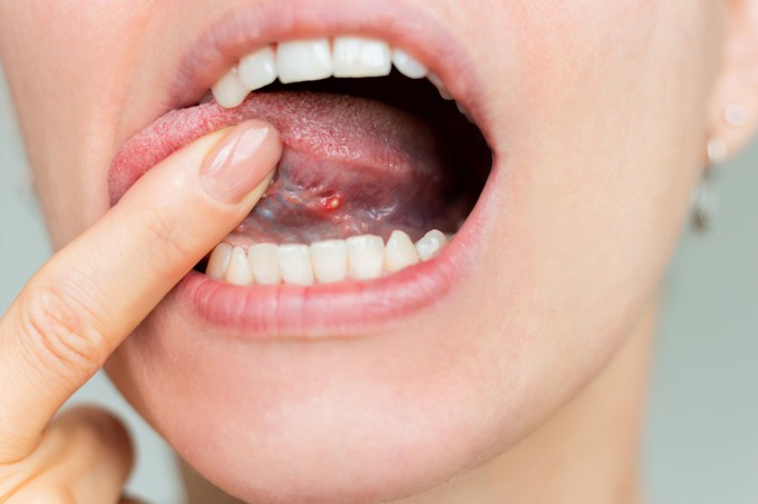 A nyelve is árulkodhat: 9 szájüregi tünet, amely B12-vitamin-hiányra figyelmeztethet című cikk nyitóképe