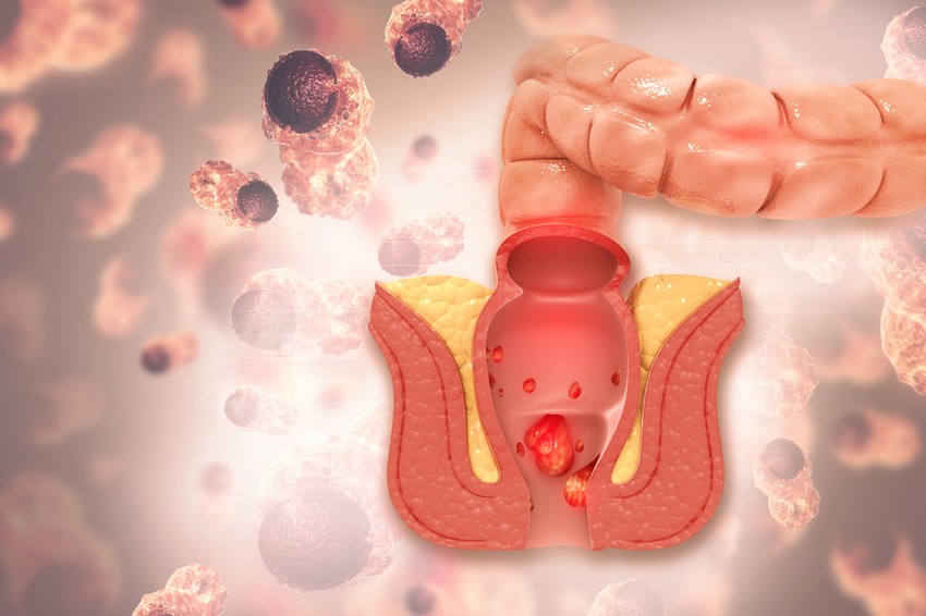 Az aranyér a végbélnyílás körül és a végbélben található erek tágulata, duzzanata, amelyek leginkább az alsó végtagon megjelenő visszerességhez hasonlítanak.