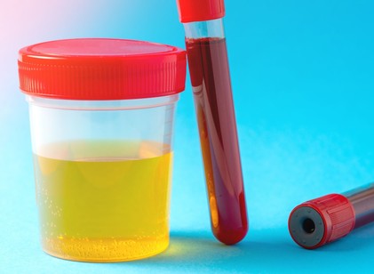 Öt módszer a magas húgysavszint csökkentésére című cikk nyitóképe