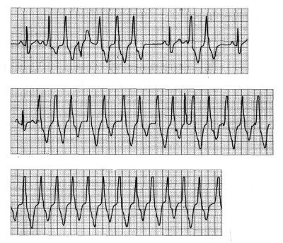 Még mindig az EKG-ról: néhány érdekesség