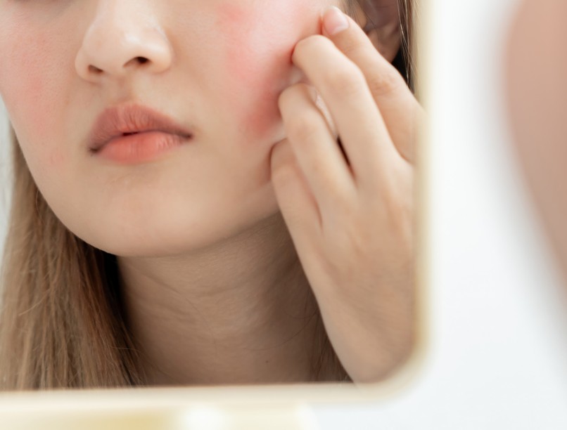 rosacea piros arc, orr, kezelés