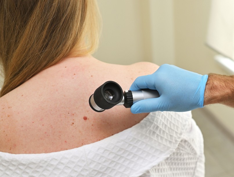 bőrrák jel tünet bőrgyógyász melanóma