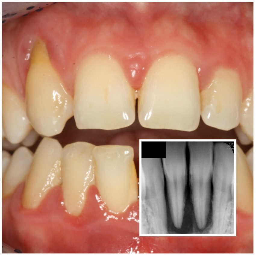 Kezeletlen fogágybetegség: így veszítsünk el egy fogat 10 év alatt (X)