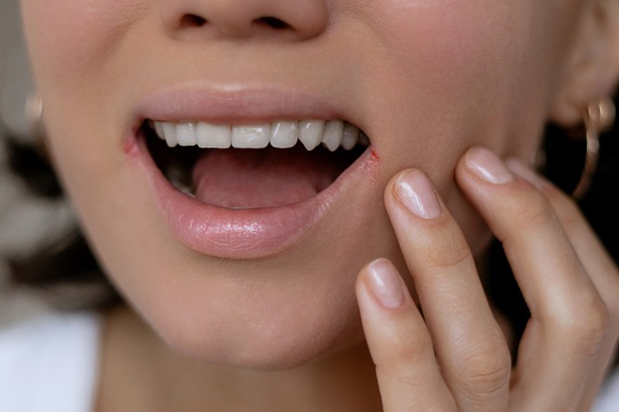 Herpesz fellángolása: a vírus vár, jön-megy ahogy akar, vagy beleszólhatunk mi is? című cikk nyitóképe