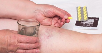  A szakorvos elmagyarázza mitől védenek a véralvadásgátlók, és mikor érdemes gyógyszert váltani 