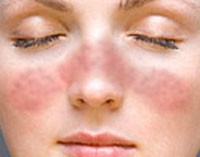 Amiről nem sokat tudunk: a lupus-betegség (SLE)