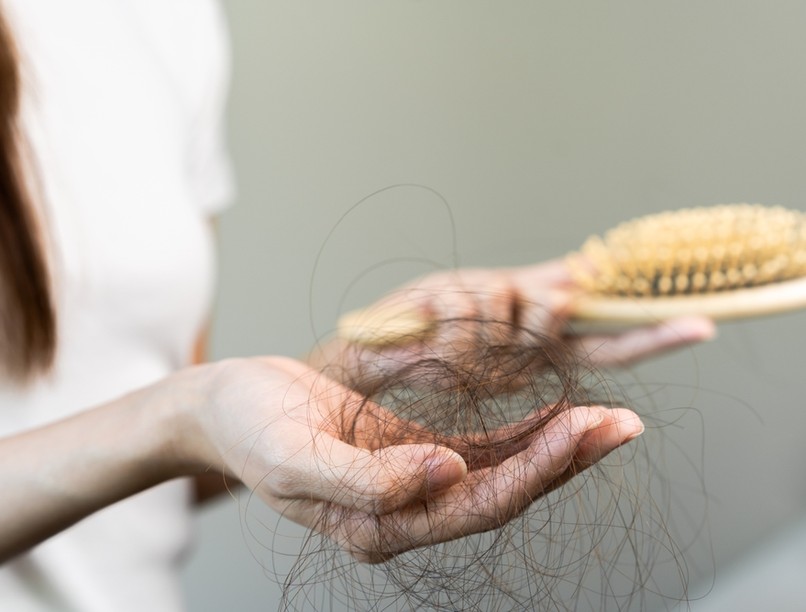 hajhullás, alopecia, örökletes, koronavírus, covid