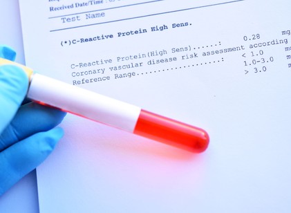 Mit árul el a CRP-érték az egészségi állapotunkról? Ezt üzeni a szervezete, ha a CRP-eredménye magas című cikk nyitóképe