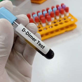 Mit jelent a D-dimer érték a laborleleten? című cikk nyitóképe