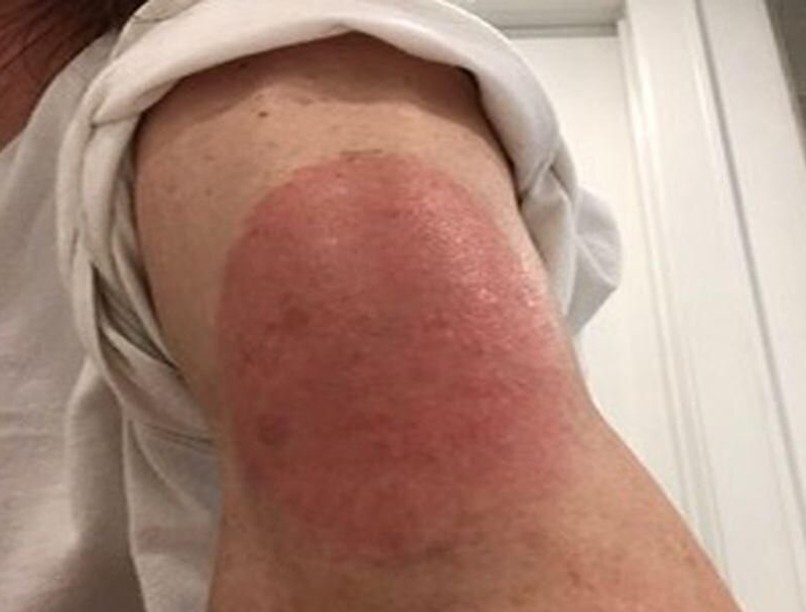 Bőrkiütés védőoltás után