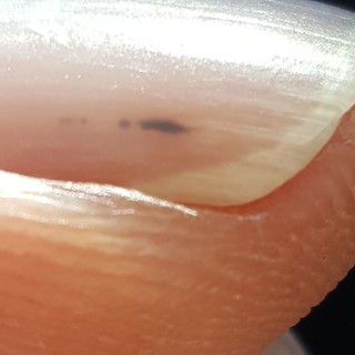 Szálkavérzések: ezt jelenti, ha fekete vonalak jelennek meg a körmökön című cikk nyitóképe