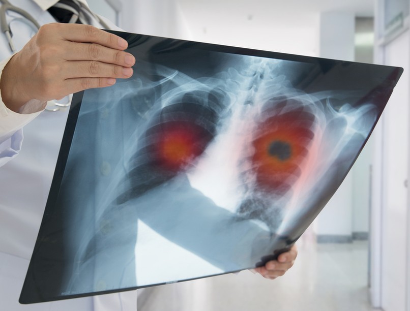 tüdőrák, daganat, tüdőfibrózis, koronavírus