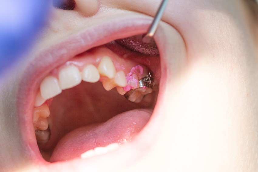 A rosszul illeszkedő, sérült, törött vagy túlságosan kopott, régi műfogsor komoly kellemetlenségeket, fájdalmakat okozhat, és számos betegség rizikóját is növelheti.