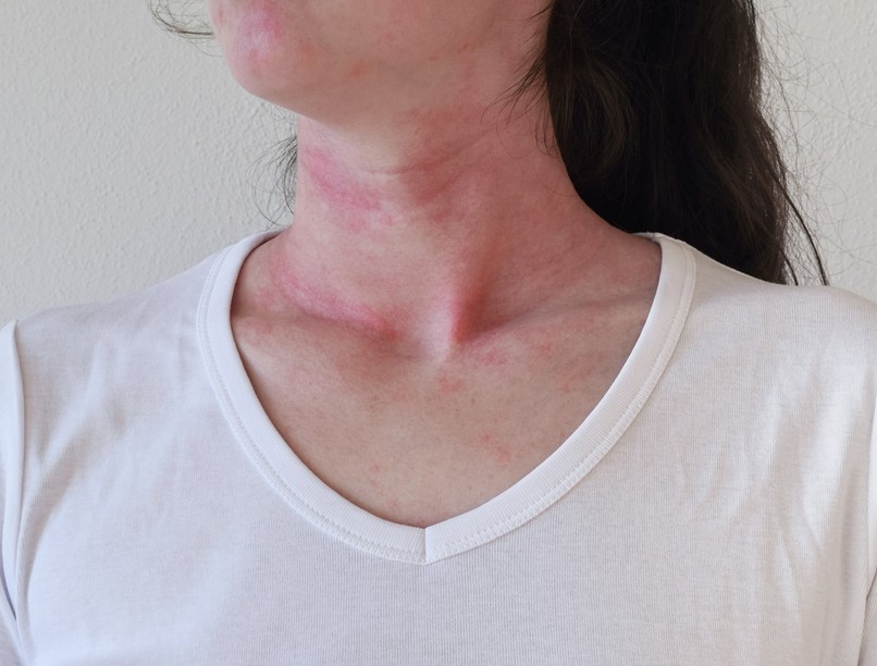 anafilaxia, allergia, reakció, tünet