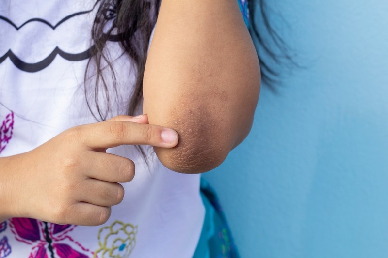 Kinél és miért  alakul ki a scleroderma?