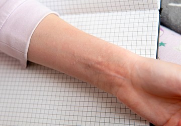 Esti csalánkütés: ezt jelenti,ha estére rosszabb a helyzet, mint napközben volt