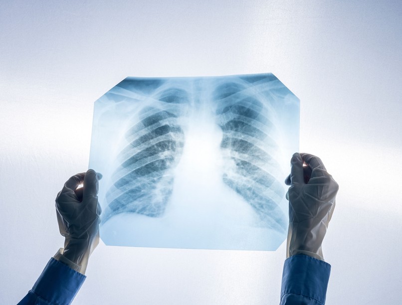 tüdőrák vizsgálat tüdőtükrözés biopszia