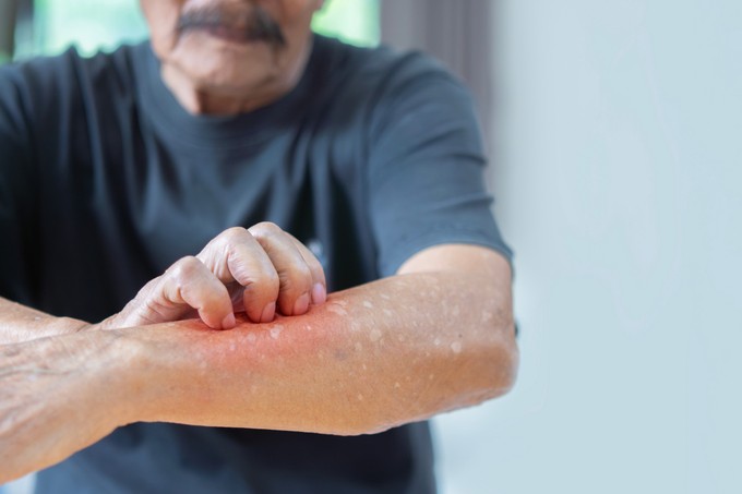 Apukám rühes, elkaphatjuk mi is, akik vele élünk? Az orvos válaszol című cikk nyitóképe