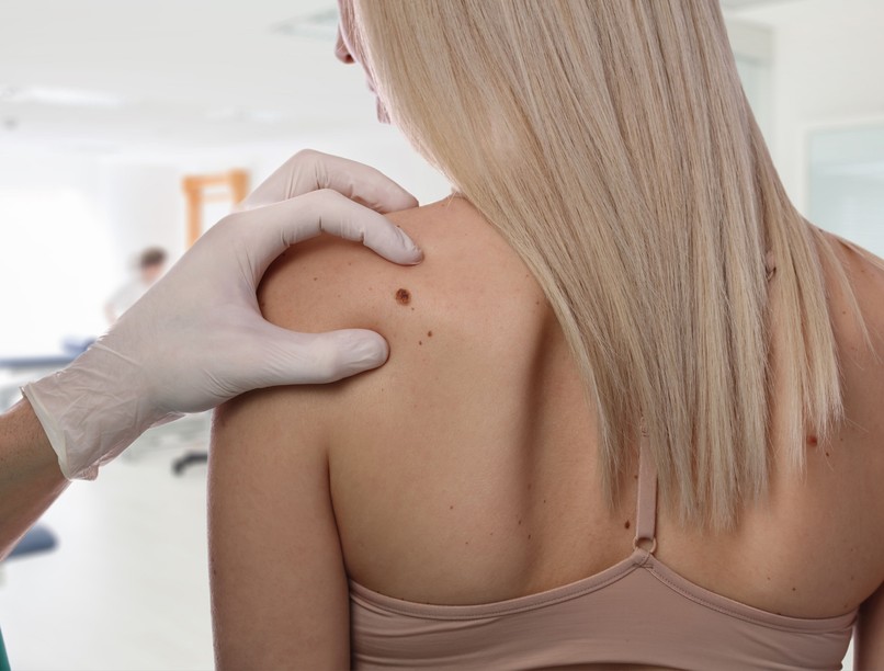 vérző anyajegy bőrrák tünet melanoma