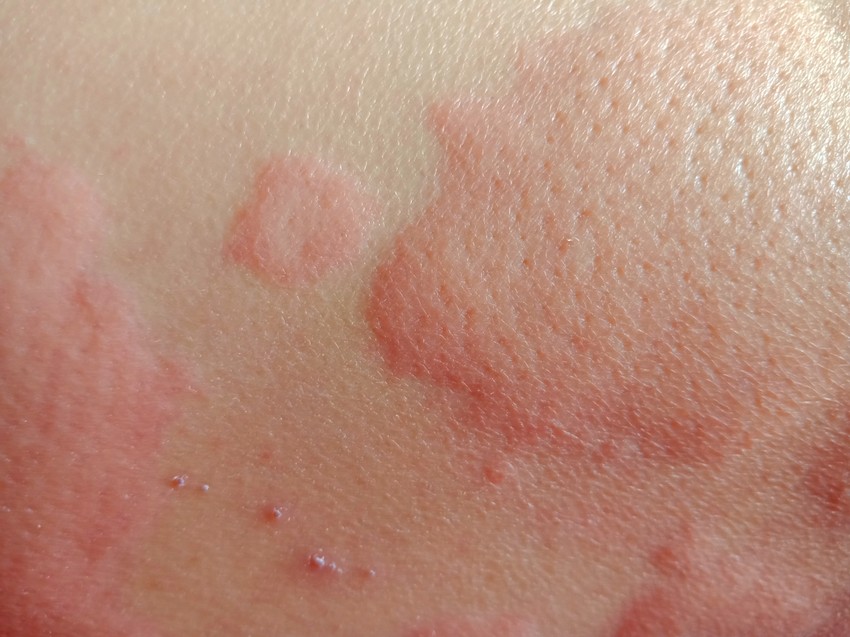 A pelenkával fedett terület gyulladt, vörös, érzékeny, időnként felszínes apró hámhiányok, kisebb hólyagok is megjelennek.