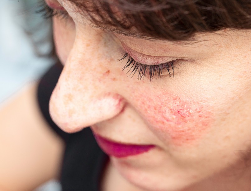 Rosaceás bőr kezelése ápolása