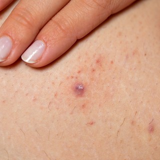 Szőrtüszőgyulladás, szőrbenövés oka, tünetei és kezelése című cikk nyitóképe