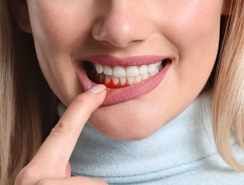 vérző fogíny fogínyvérzés