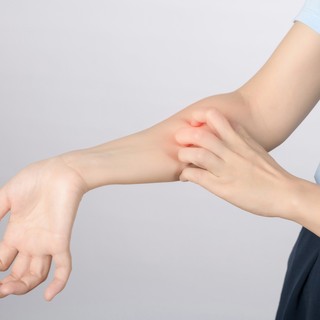 Hisztamin allergia – tünetek, amik elárulják, ha érintett című cikk nyitóképe