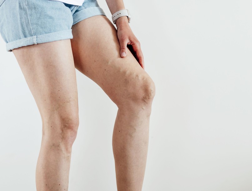 ragasztásos visszérműtét visszértágulat nyár meleg