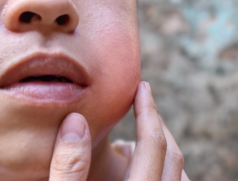 Mumpsz tünet, vizsgálat kezelés