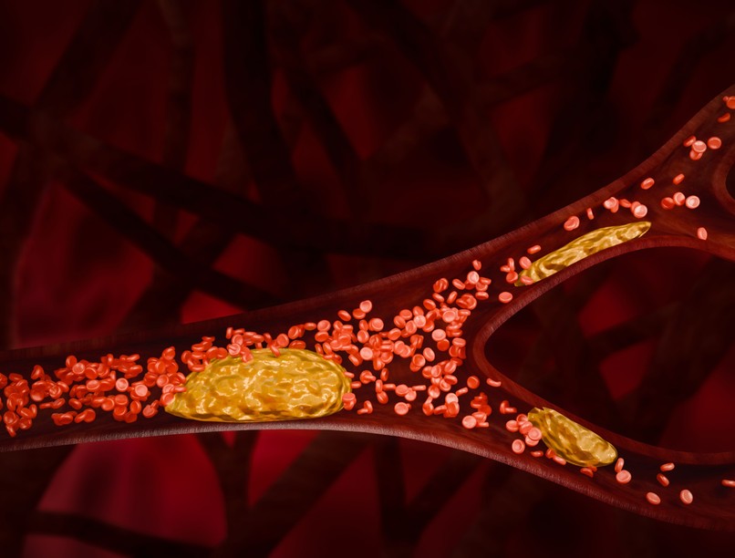 mi okoz plakk artéria