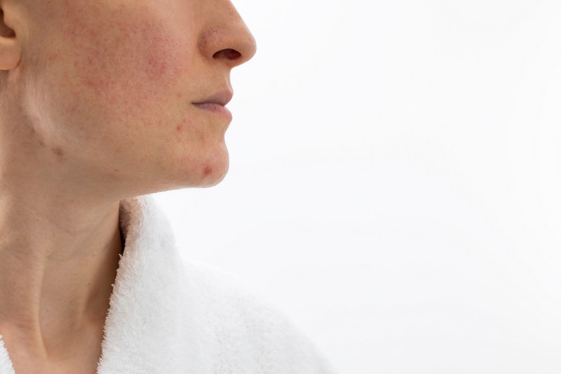 Vörös arc és pókhálóerek az orron? Ez a bőrgyógyász tanácsa, ha rosaceája van