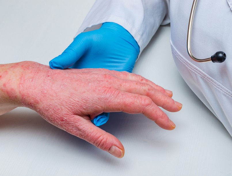 hámlás, kóros hámlás, oka, tünete, lefolyása, kezelése, fertőzés