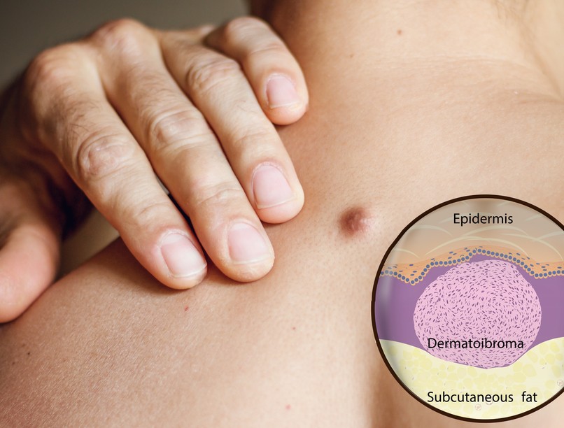 szemölcs bőrkinövésoka kezelése