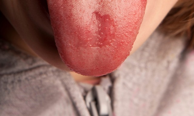 Nyelven lévő dudorok, sebek – van, hogy súlyos állapotot jeleznek