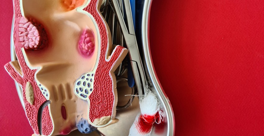 Ugyan a pontos okát jelenleg még nem ismerjük, de számos olyan tényező létezik, amely igazoltan fokozza a vastagbélrák kialakulásának esélyét.