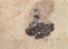 Az árnyékunk segít megelőzni a bőrrákot!