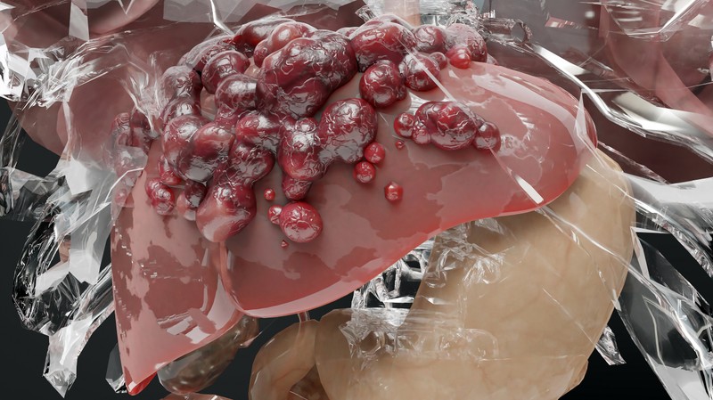 Alkoholos májkárosodás: tünetei, vizsgálata és kezelési lehetőségei