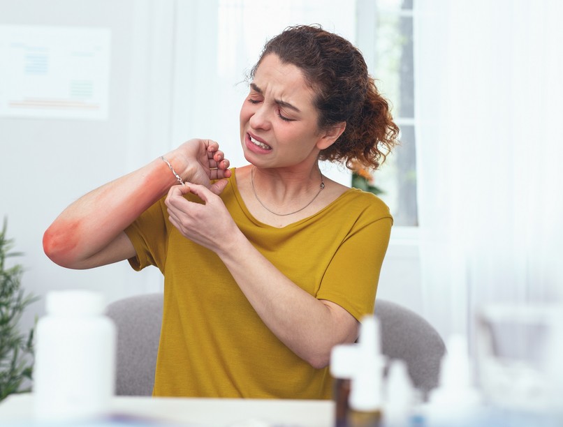 allergia nikkelallergia fémallergia