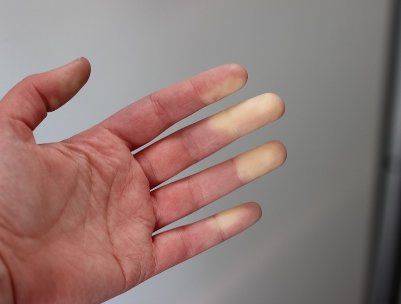 raynaud szindróma oka, tünete, autoimmun kutatás