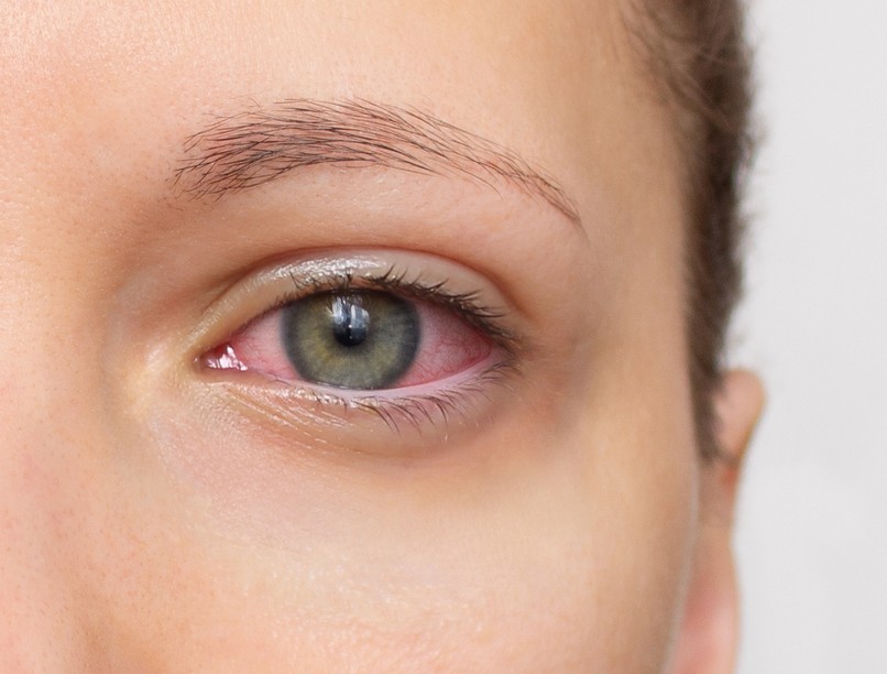 Kötőhártya-gyulladás tünetei