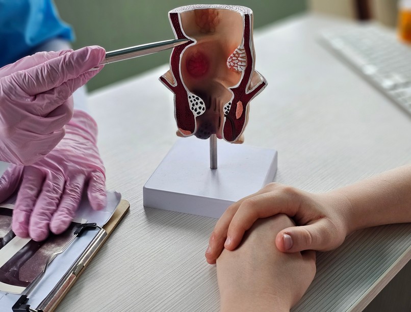 aranyér kiújulás ellen