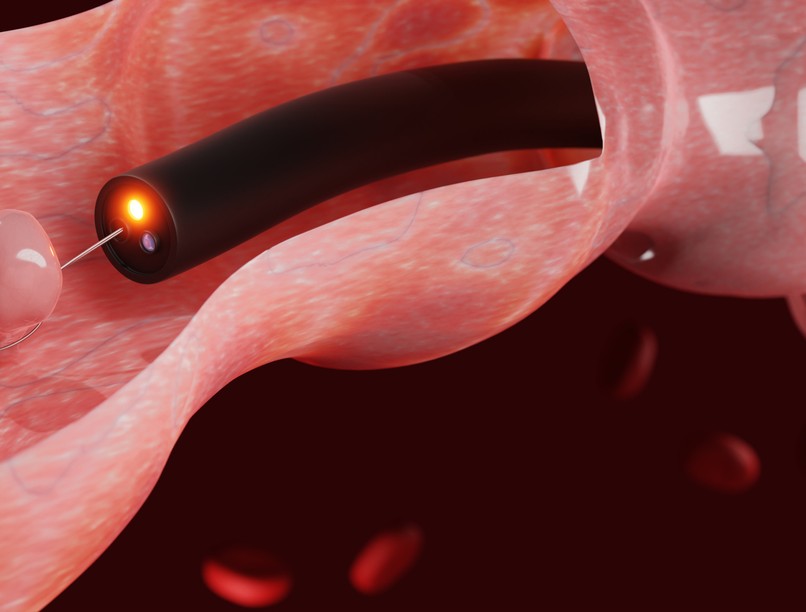 rosszindulatú vastagbéldaganat, szűrővizsgálat, kolonoszkópia, rák, bélrák, diagnosztizálás, bélrendszer, polip
